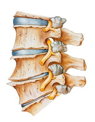Degenerative Disc Disease | Spine Associates | Back to normal...